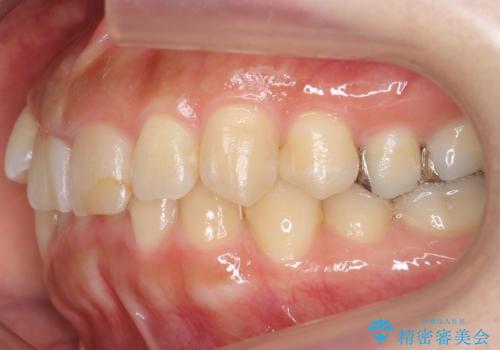 前歯のがたつき ガミースマイルの改善の治療前