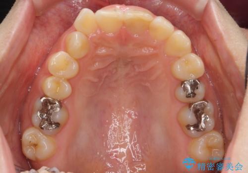 前歯のがたつき ガミースマイルの改善の治療前