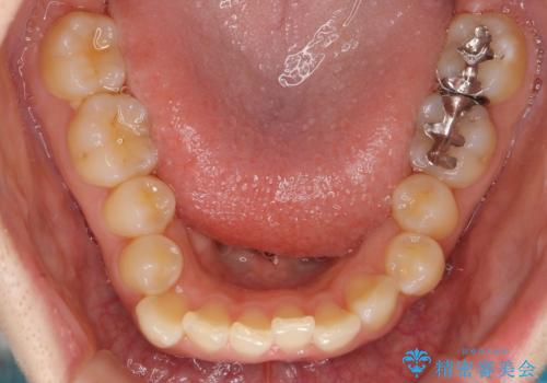 前歯のがたつき ガミースマイルの改善の治療前