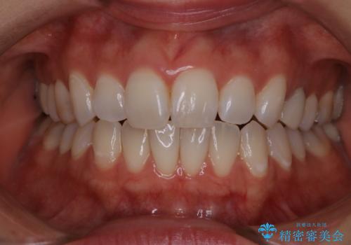 歯科医院にて、ホワイトニングの治療前