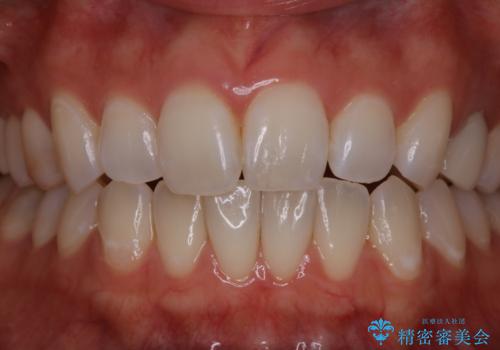 歯科医院にて、ホワイトニングの治療前