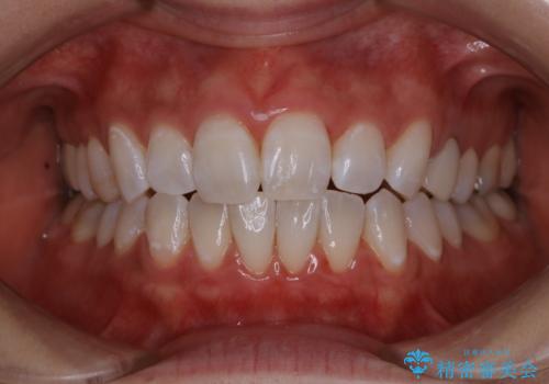 歯科医院にて、ホワイトニングの治療後