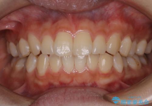 PMTCでツルツルな歯にの治療後