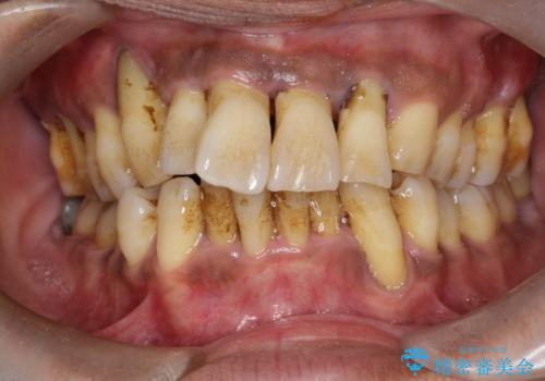歯周病の初期治療　歯石除去とクリーニングのみでの治療