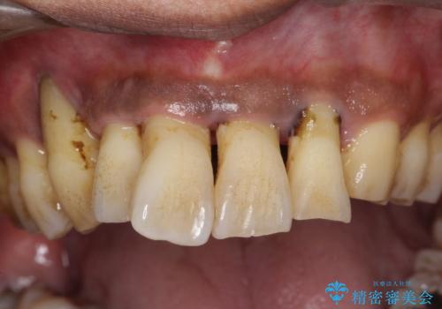 歯周病の初期治療　歯石除去とクリーニングのみでの治療の治療前