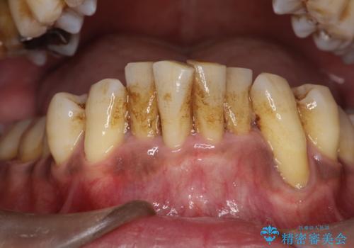 歯周病の初期治療 歯石除去とクリーニングのみでの治療の治療前