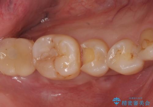 セラミックインレーによる治療の治療中