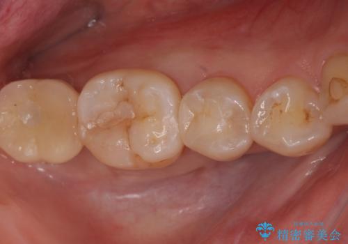 セラミックインレーによる治療の症例 治療後