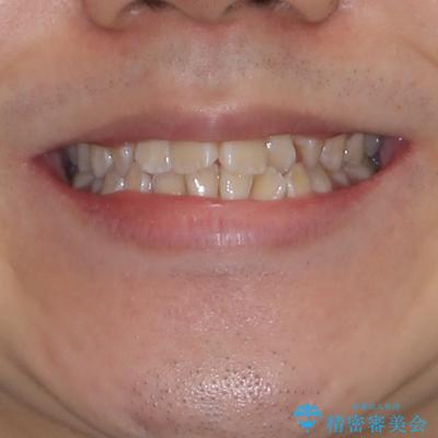 非抜歯ワイヤー装置による、短期間での矯正治療の治療前（顔貌）