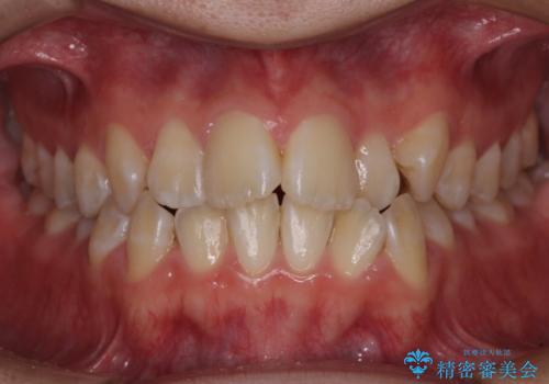 非抜歯ワイヤー装置による、短期間での矯正治療の症例 治療前