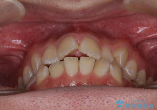 非抜歯ワイヤー装置による、短期間での矯正治療の治療前