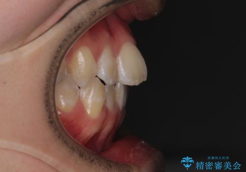 非抜歯ワイヤー装置による、短期間での矯正治療の治療前