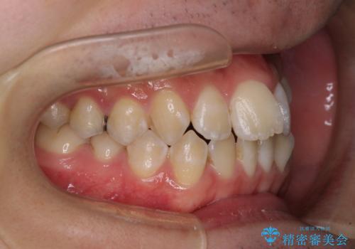 非抜歯ワイヤー装置による、短期間での矯正治療の治療前