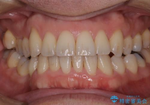 紅茶のステインをきれいにしたいの治療前