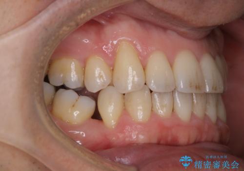 紅茶のステインをきれいにしたいの治療前