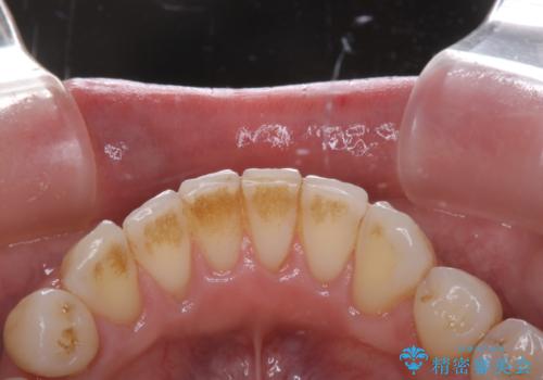 紅茶のステインをきれいにしたいの治療前