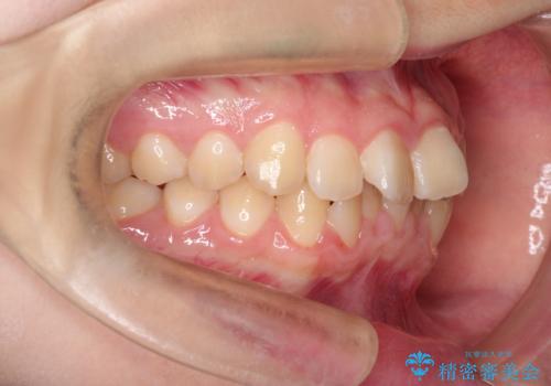 なるべく通院回数を減らして矯正したい インビザラインでのガタガタ矯正の治療前