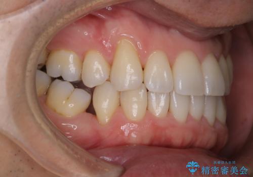 紅茶のステインをきれいにしたいの治療後