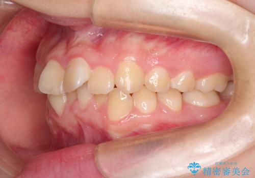 なるべく通院回数を減らして矯正したい インビザラインでのガタガタ矯正の治療前