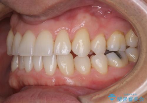 紅茶のステインをきれいにしたいの治療後