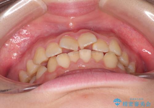 なるべく通院回数を減らして矯正したい インビザラインでのガタガタ矯正の治療前