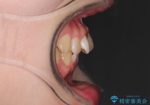 なるべく通院回数を減らして矯正したい インビザラインでのガタガタ矯正の治療前