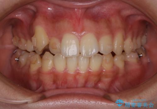 八重歯の解消とインプラントの下準備をインビザラインでの治療中