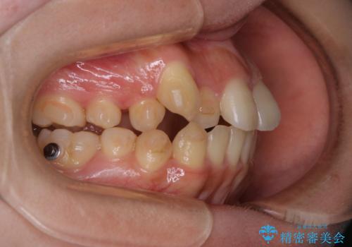 八重歯の解消とインプラントの下準備をインビザラインでの治療中