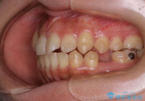 八重歯の解消とインプラントの下準備をインビザラインでの治療中