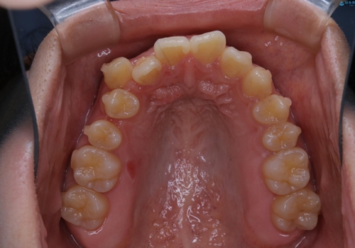 八重歯の解消とインプラントの下準備をインビザラインでの治療中
