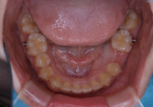 八重歯の解消とインプラントの下準備をインビザラインでの治療中