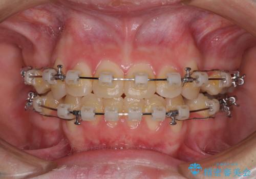 上下の出っ歯を治したい ワイヤー装置による抜歯矯正の治療中