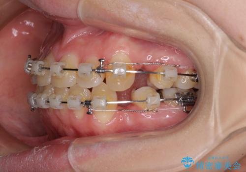 上下の出っ歯を治したい　ワイヤー装置による抜歯矯正の治療中