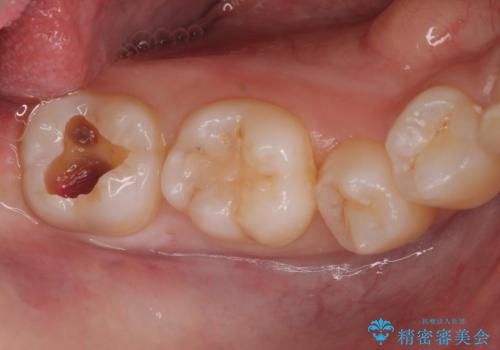 奥歯の深い虫歯の治療中