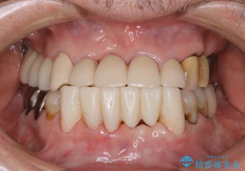 空気が漏れて喋りづらい:適合の良いセラミックで歯をつくるの治療中