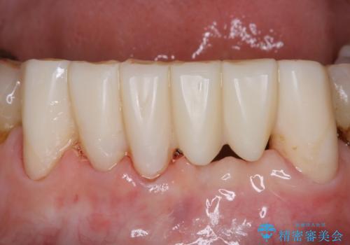 空気が漏れて喋りづらい:適合の良いセラミックで歯をつくるの治療中