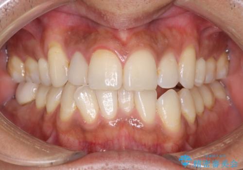 オフィスホワイトニング エクセレントコースの治療前