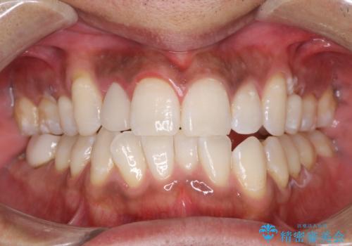 オフィスホワイトニング エクセレントコースの治療後