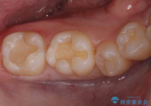 奥歯の深い虫歯の治療中