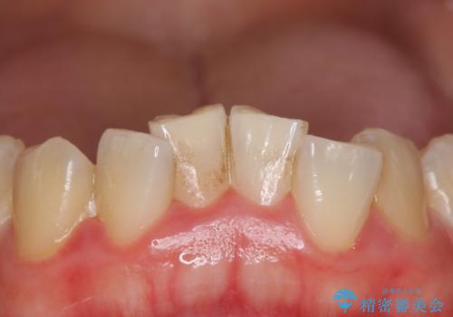 治療の前にオフィスホワイトニングの治療前