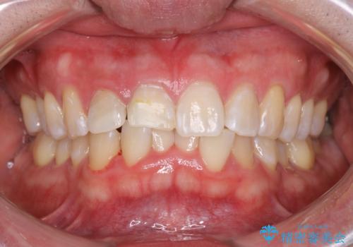 治療の前にオフィスホワイトニングの症例 治療後