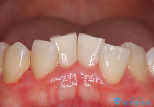 治療の前にオフィスホワイトニングの治療後