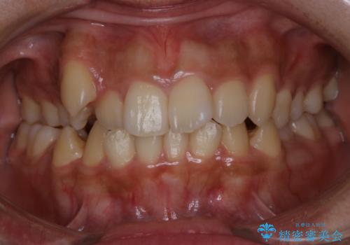 八重歯の解消とインプラントの下準備をインビザラインでの治療前