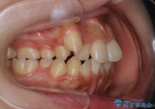 八重歯の解消とインプラントの下準備をインビザラインでの治療前