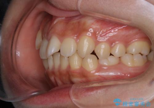八重歯の解消とインプラントの下準備をインビザラインでの治療前