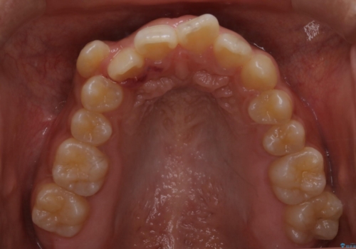 八重歯の解消とインプラントの下準備をインビザラインでの治療前