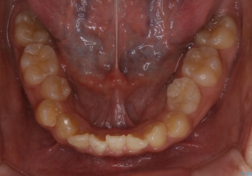 八重歯の解消とインプラントの下準備をインビザラインでの治療前