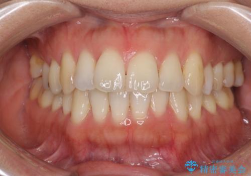 後戻りの再矯正治療と欠損部の補綴治療の症例 治療前