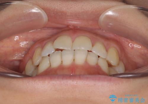 後戻りの再矯正治療と欠損部の補綴治療の治療前