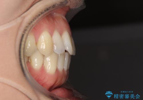 後戻りの再矯正治療と欠損部の補綴治療の治療前